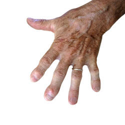 Artrosi delle mani